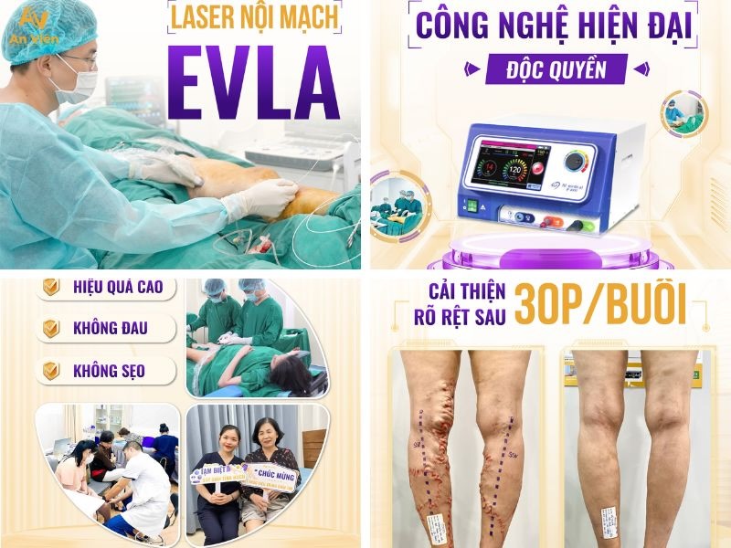 Đứng không nổi quá 10 phút, tưởng phải sống chung với bệnh: Hành trình lấy lại đôi chân tự tin tại Tĩnh mạch An Viên 9 Điều trị bằng phương pháp EVLA